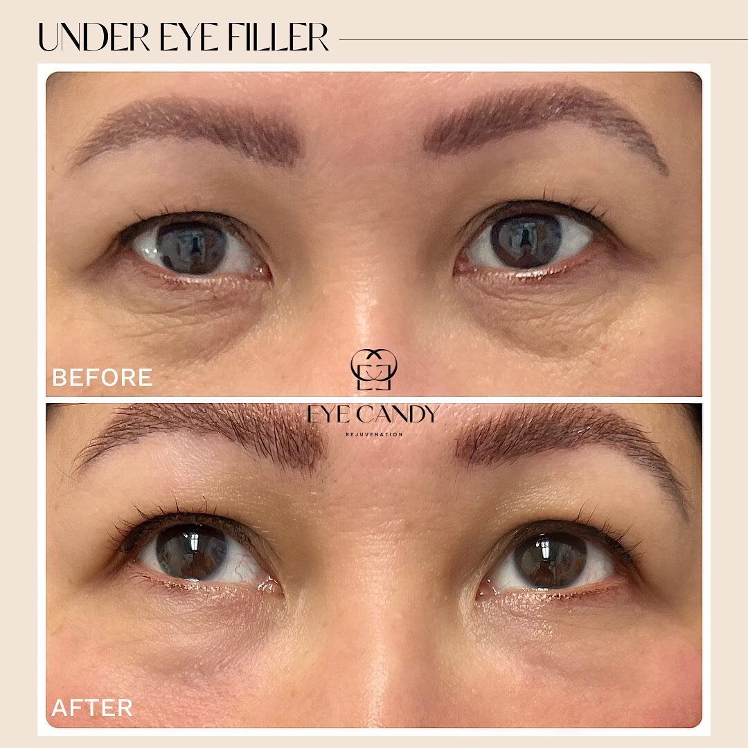 👋🏽 Bye bye bye to those eye bags! This patient was treated with one syringe of Belotero Soft to her tear trough.
💉 Under eye filler can treat stubborn bags, wrinkles, and dark circles (PS, your eye cream won&rsquo;t help for long.😉) 
Work done by