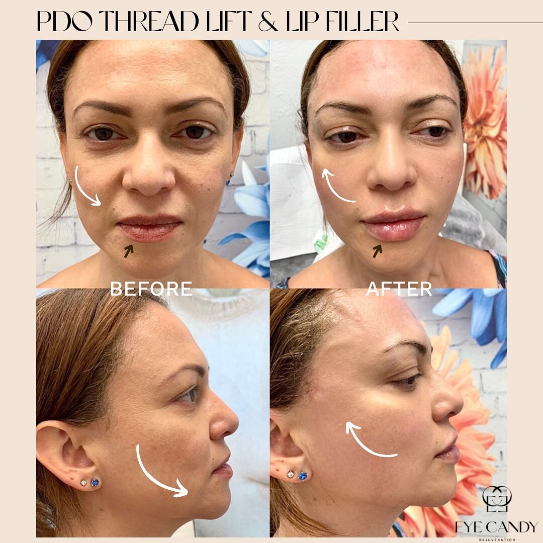 You can look years younger with our non-surgical face lift &amp; Lip Filler 😍

This beautiful client has done PDO Thread Lift with 20 Mono Threads help smoothing her forehead &amp; marionette lines, and 4 cog lifting threads per side applied to her 