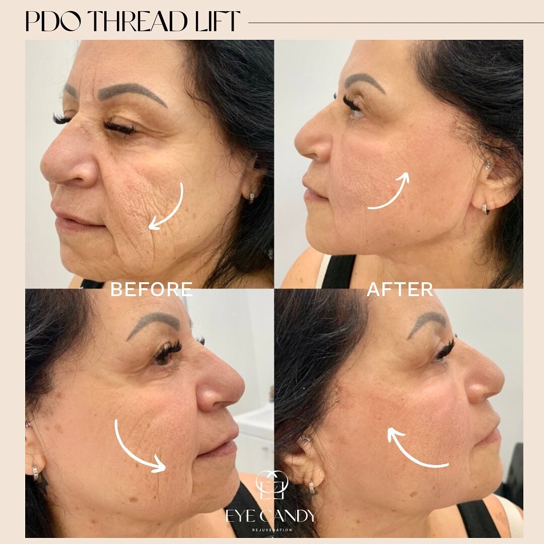 You can look years younger with our non-surgical face lift! 😍

This beautiful client has done PDO Thread Lift with 20 Mono Threads help smoothing her lower face, and lift her skin with 6 cog lifting threads per side 😍
*Work done by nurse Somaly!

*