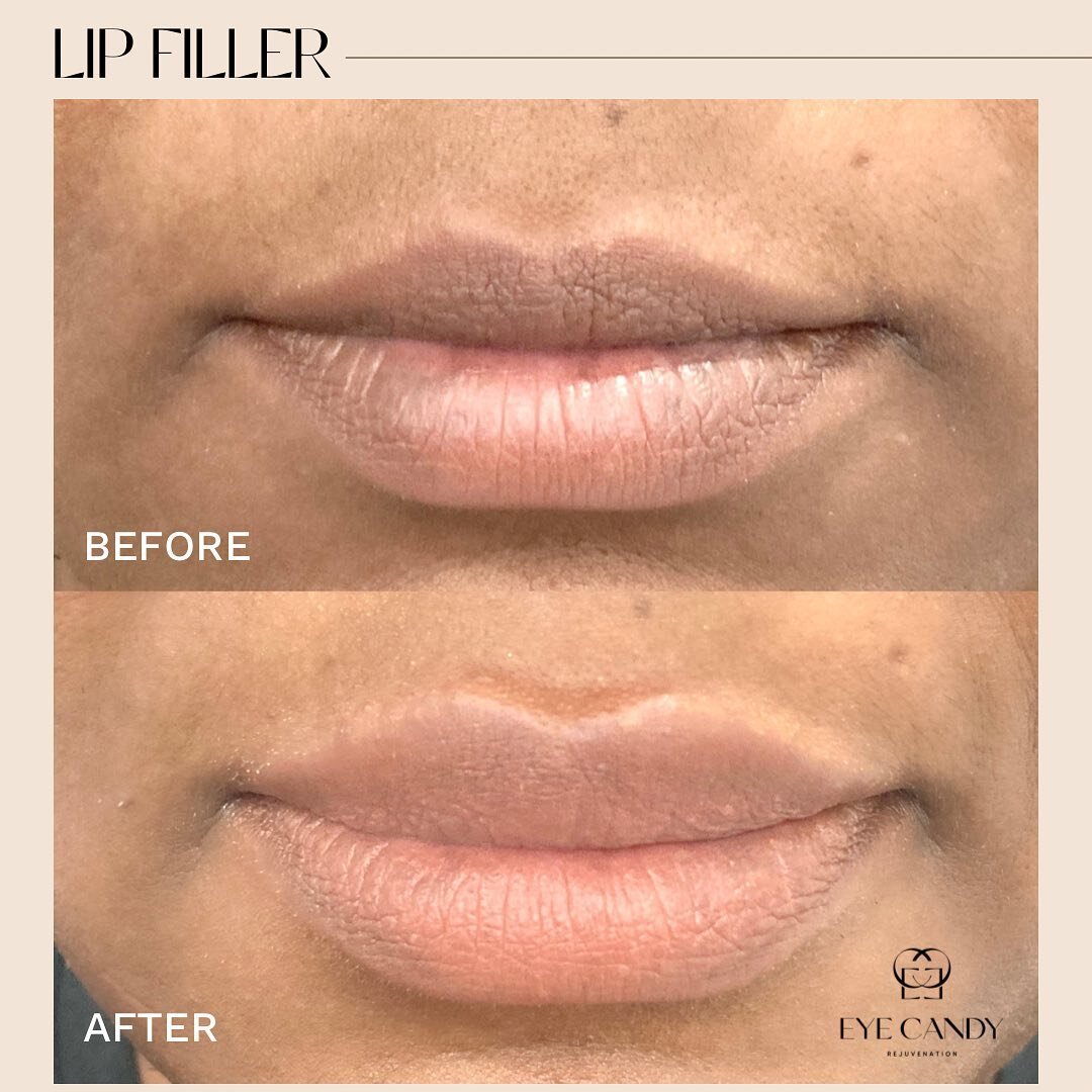 The perfect amount of filler to achieve the hydrated plump look!🫦

This is after 2 weeks Lip Filler with 1 ml of @juvederm Filler. Work done by Nurse Alex!💗

*Photos taken before and immediately after treatment. Swelling and bruising are normal and