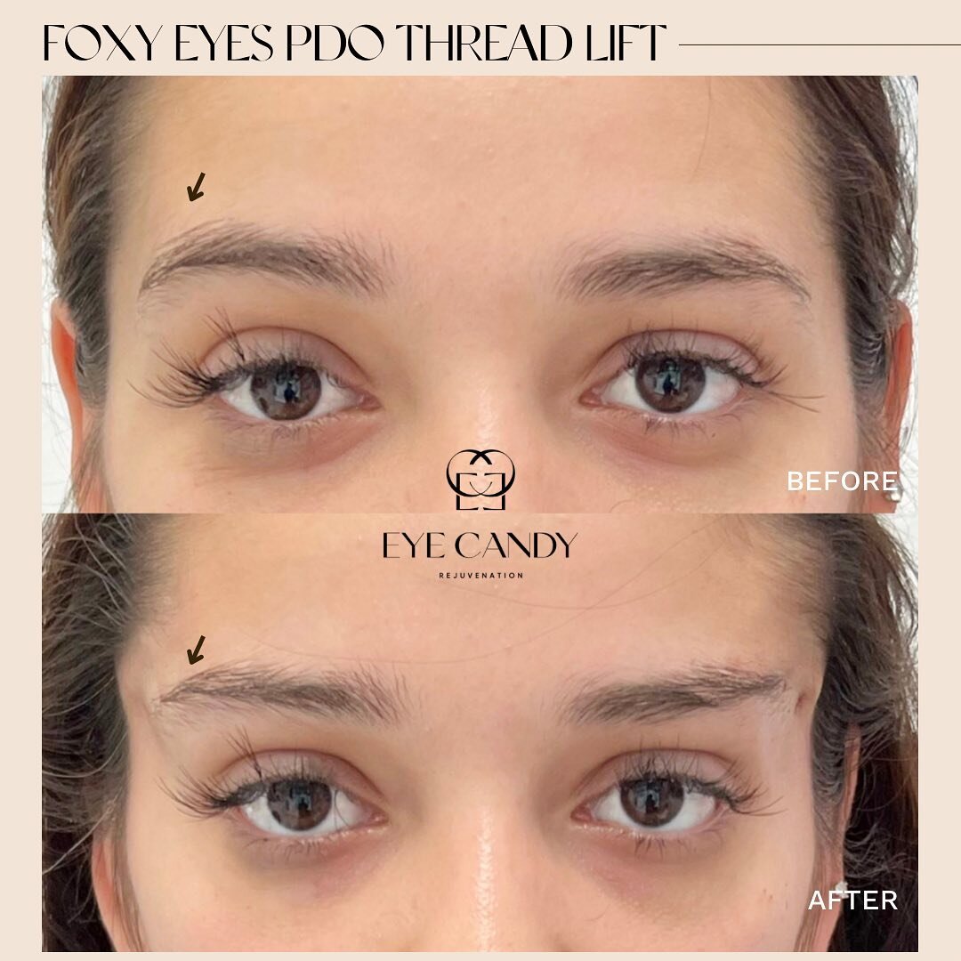 Beautiful Foxy Eyes Thread Lift for this beauty 💗✨

This treatment is a minimally invasive procedure that uses dissolvable threads to lift and elongate the eye in order to create a more almond shape while simultaneously lifting the brow tail.

Work 