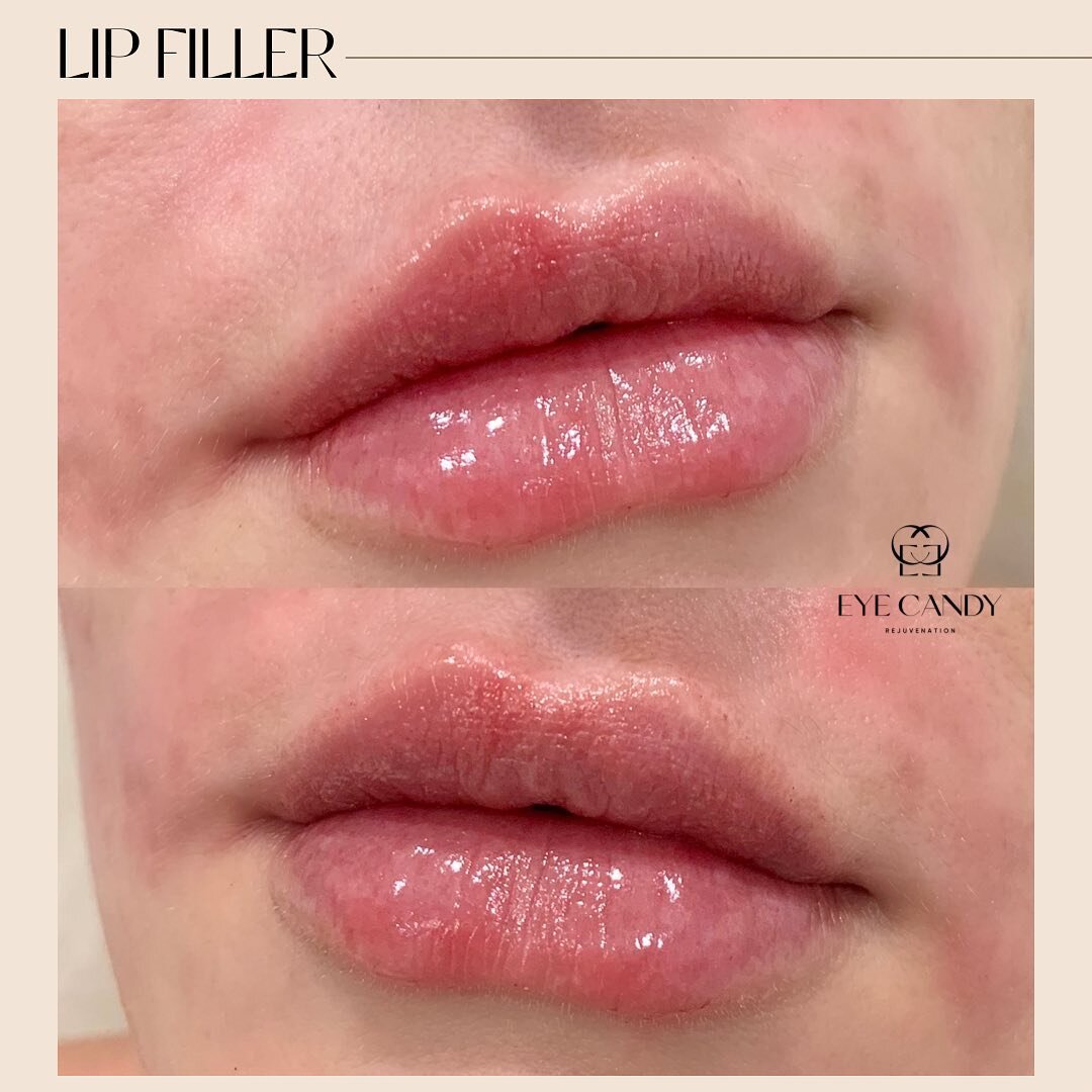 Balanced, Hydrated, Defined Natural Lips! 👄✨

Our nurse custom-created this beautiful shape and definition using 1 syringe of Restylane Kysse!
*Work done by Nurse Somaly.

*Photos taken before and immediately after treatment. Swelling and bruising a