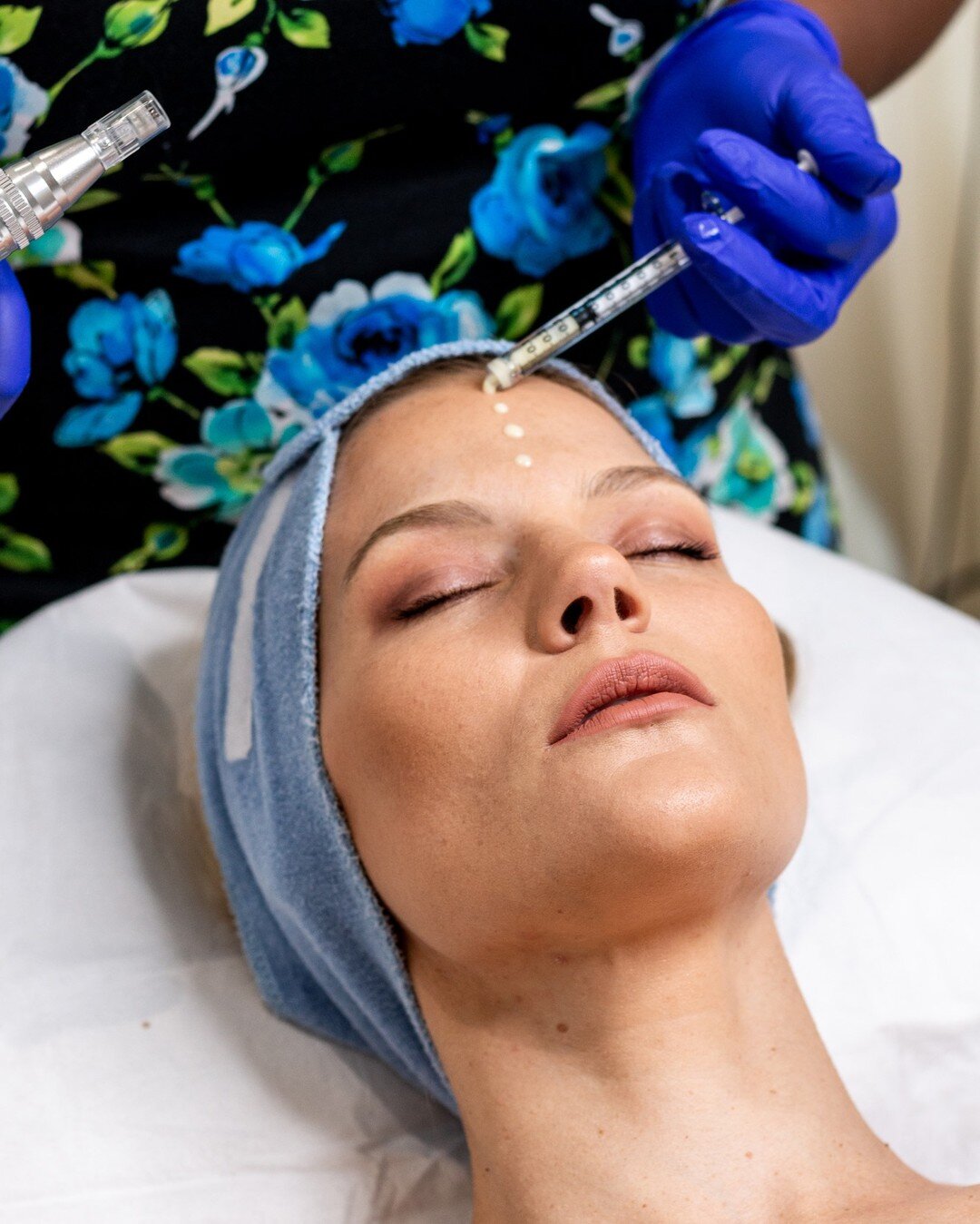 Our winter microneedling promotion ends soon! Book today and get 15% off any microneedling treatment including Anti-Ageing, Scarring, Acne &amp; Pigmentation.

https://www.worldoffaces.co.za/treatment-menu

#Winter #Promo #Microneedling