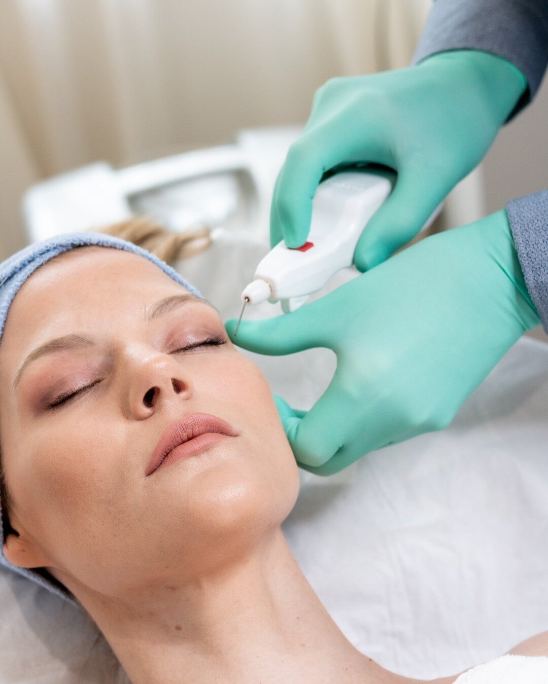 Have you heard of Plexr? Plexr is a non-surgical treatment which offers an effective alternative to surgical procedures such as blepharoplasty (eyelid correction), face/neck lift and scar. Plexr creates a plasma arc to stimulate instant contraction a
