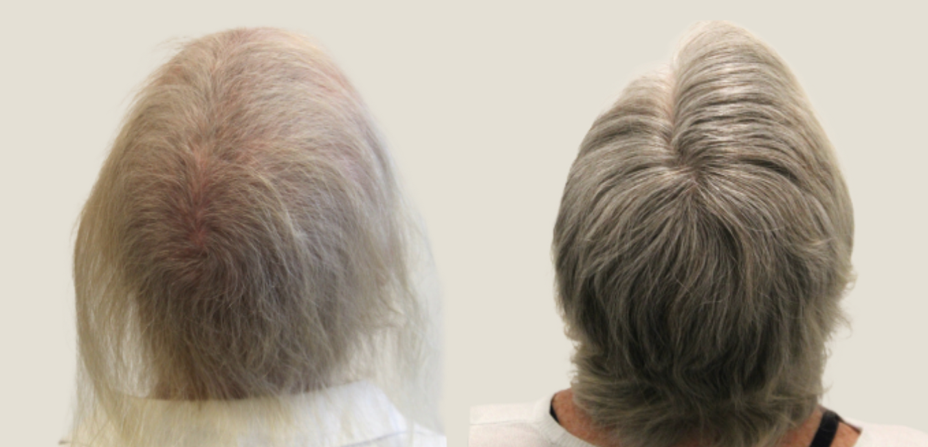 Hair Loss and Regrowth After Chemotherapy  The Patient Story