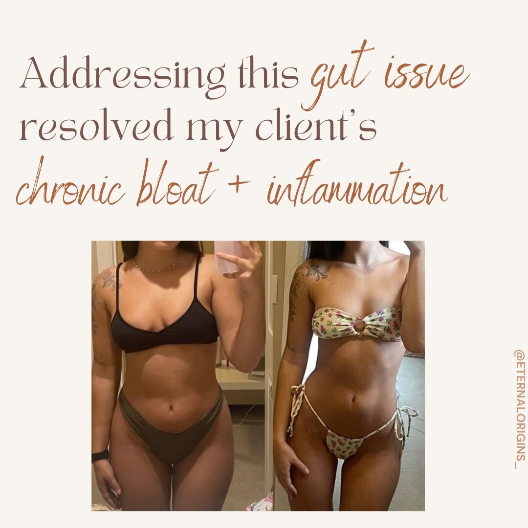 Let me introduce you to Sarah, a Gut Revive client that healed her gut naturally, dropped a ton of inflammation, and went from 1 bowel movement a week to 1 BM every day after joining the program.

She came to me with severe bloating, joint pain, stom