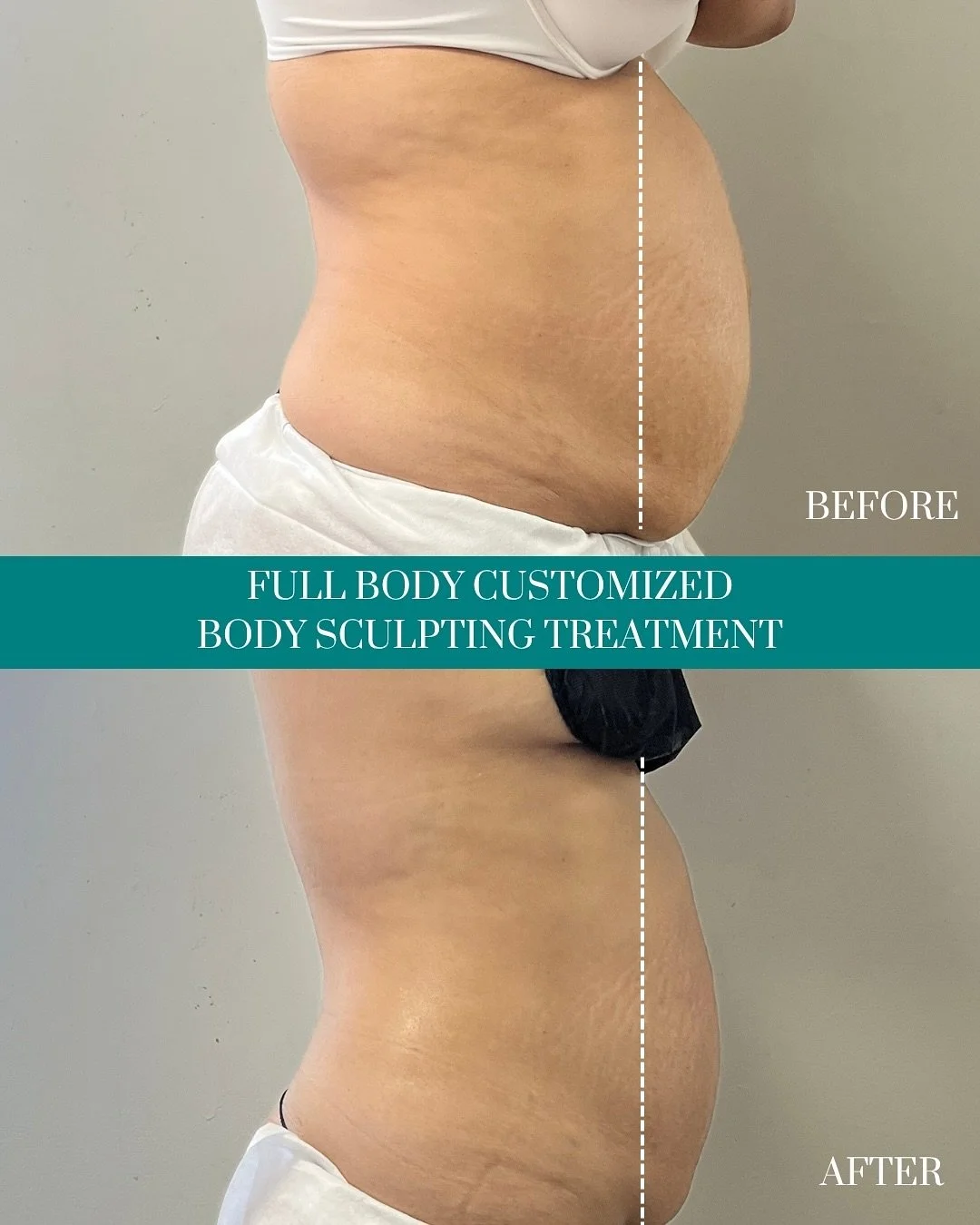 CLIENT UPDATE: We are SO proud of our amazing client!! Losing inches off her tummy 🔥 she is doing amazing during her package series of customized body sculpting treatments with us.
Here At Windows to Paradise Spa we are cheering you on every step o