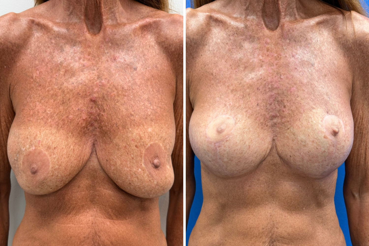 breast lift.png