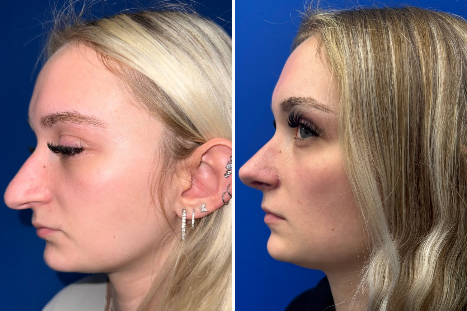 rhinoplasty-132.png