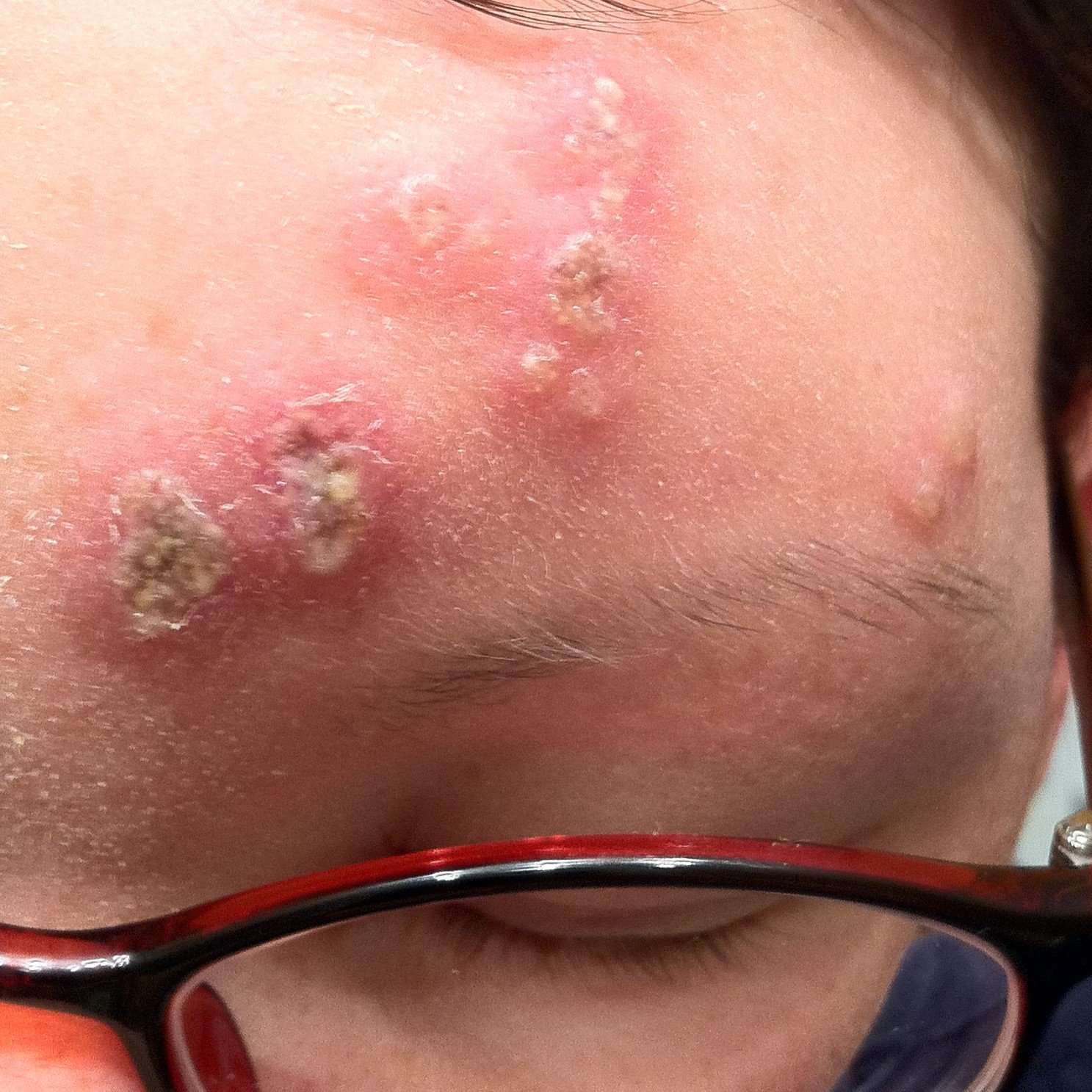 What Having Shingles Felt Like and How I Treated It