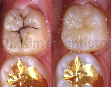 Cavity Treatment