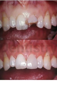 Crown Restoration