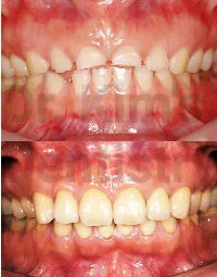 Cosmetic Gum Surgery