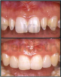 Veneer