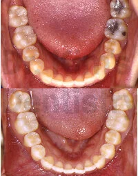 Cosmetic Filling