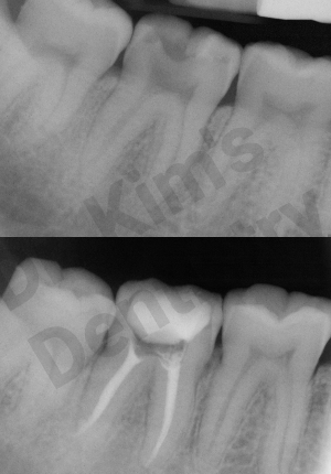 Rootcanal1.png