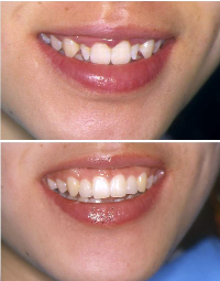 Close-up photo of a person's smile showing dental braces on the upper teeth, revealing a slight gap and some uneven teeth.