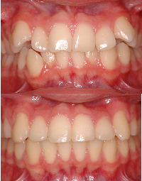Close-up of a child's teeth before and after dental braces correction, showing improved alignment.