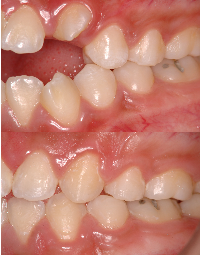 Comparison of teeth showing misaligned and crowded teeth, with the top image highlighting more severe crowding than the bottom.