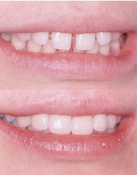 Close-up of a child's smile showing a missing front tooth and several adult teeth.