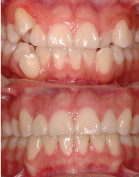 Close-up of a child's teeth showing dental crowding and misalignment in the upper and lower jaws.