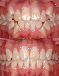 Before and After 
Severe malocclusion case 
