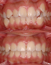 Close-up of a child's upper and lower teeth showing dental alignment and gums.