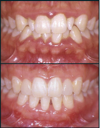 Close-up of a person's teeth showing misalignment and overcrowding, with some teeth overlapping.