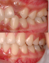 Close-up of a person's teeth showing crowded and misaligned upper and lower teeth.