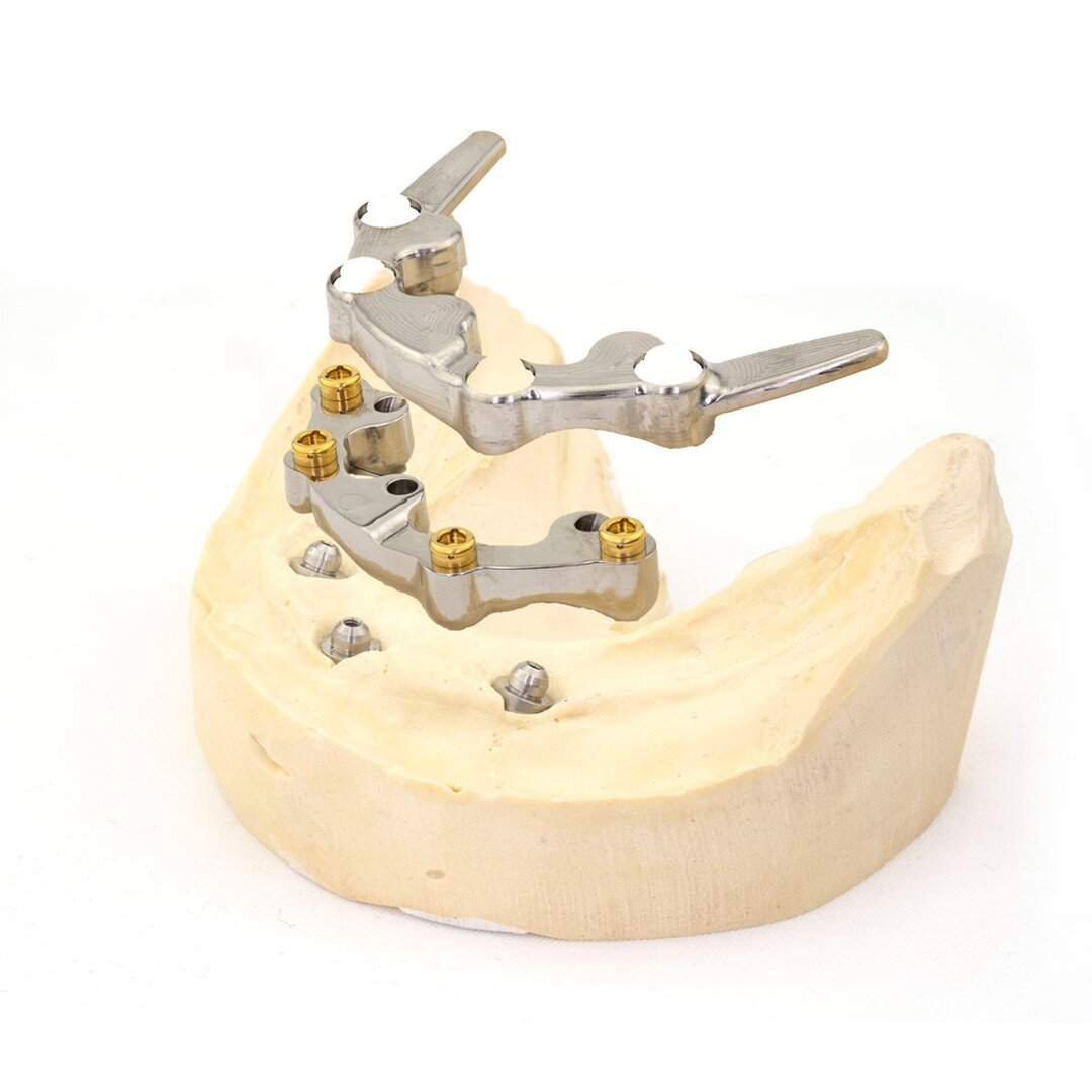 Osteon Lab Primary bar. 
(Not available for purchase by the general public.)

This unique 3 implant case required the use of a removable indication and a significant cantilever design, made possible with the titanium Osteon bar and suprastructure.

T