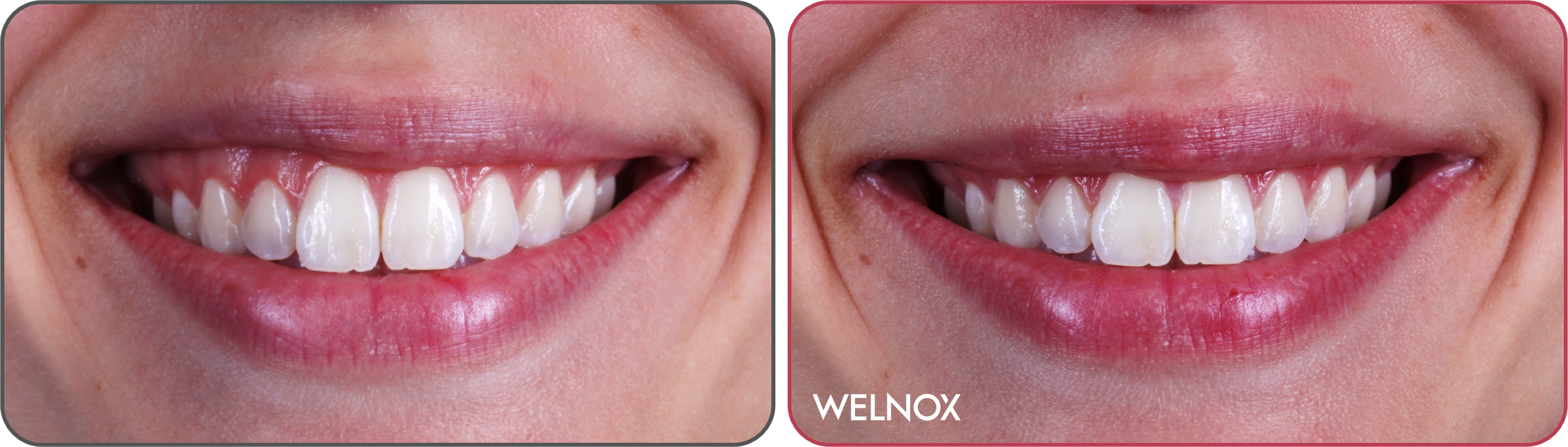 Asymmetric Gummy Smile Correction