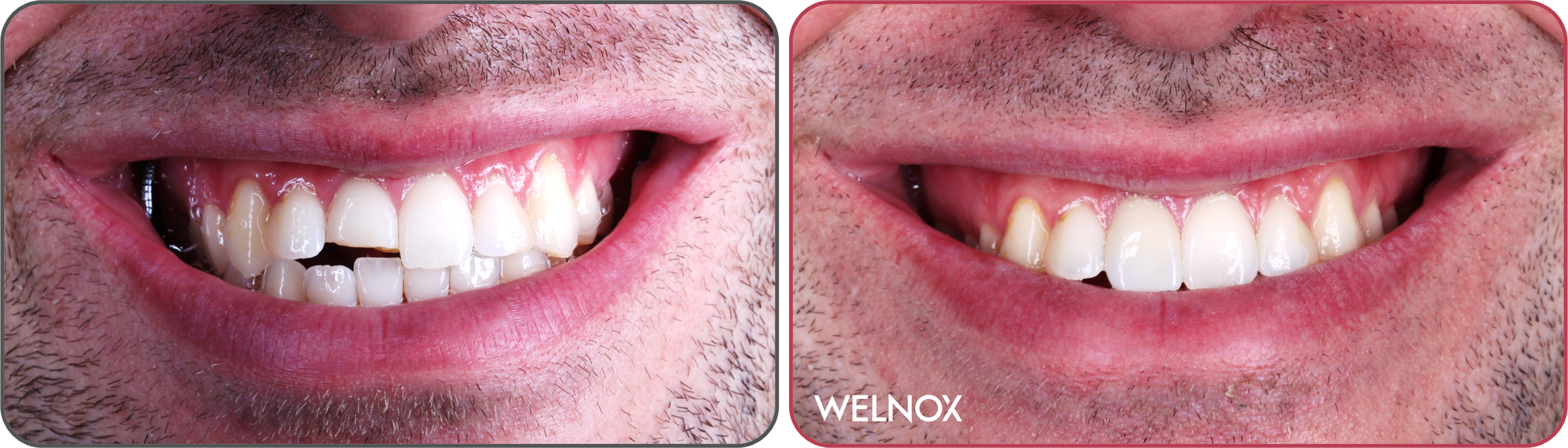 Veneers Philadelphia