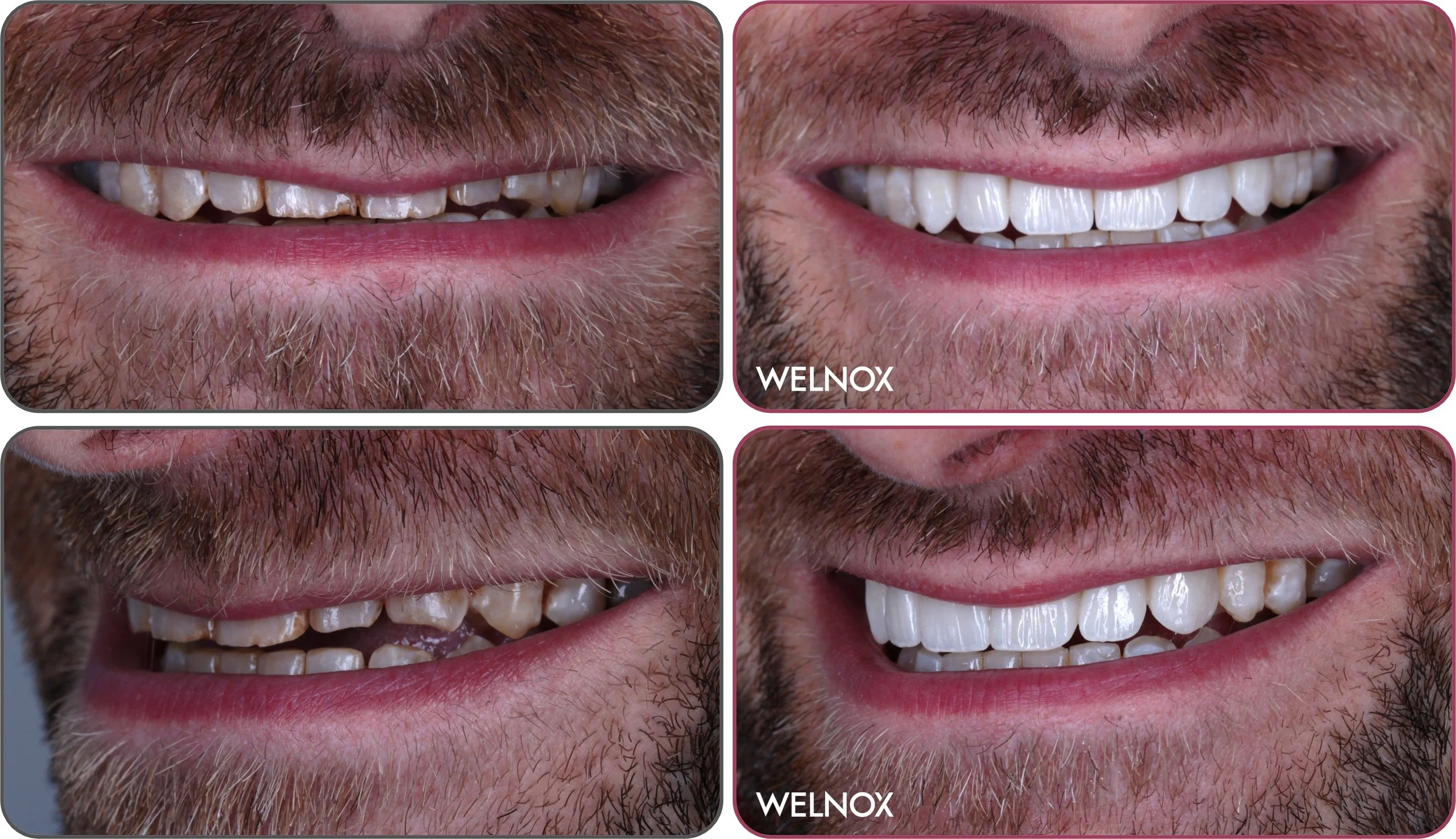 Porcelain Veneers