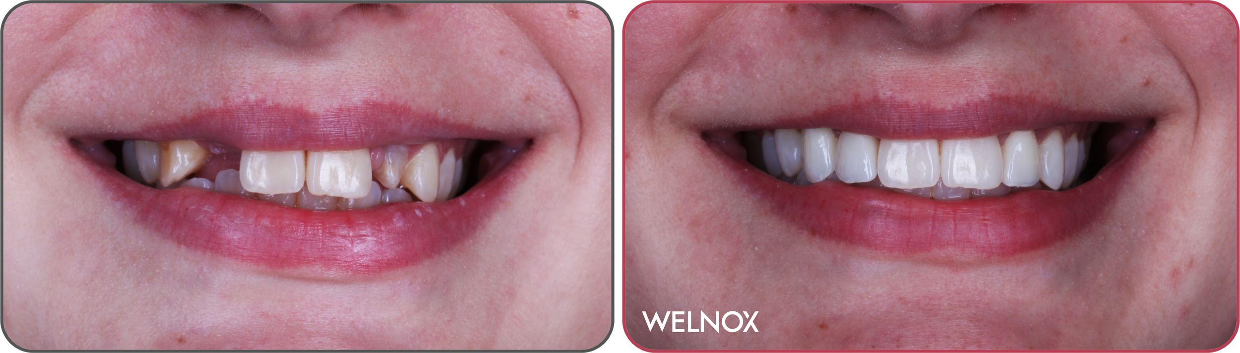 zirconia crown and bridge