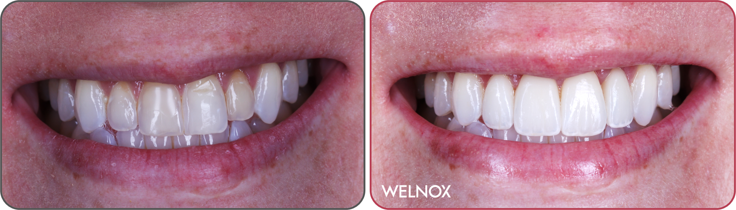 Three zirconia veneers and one zirconia crown