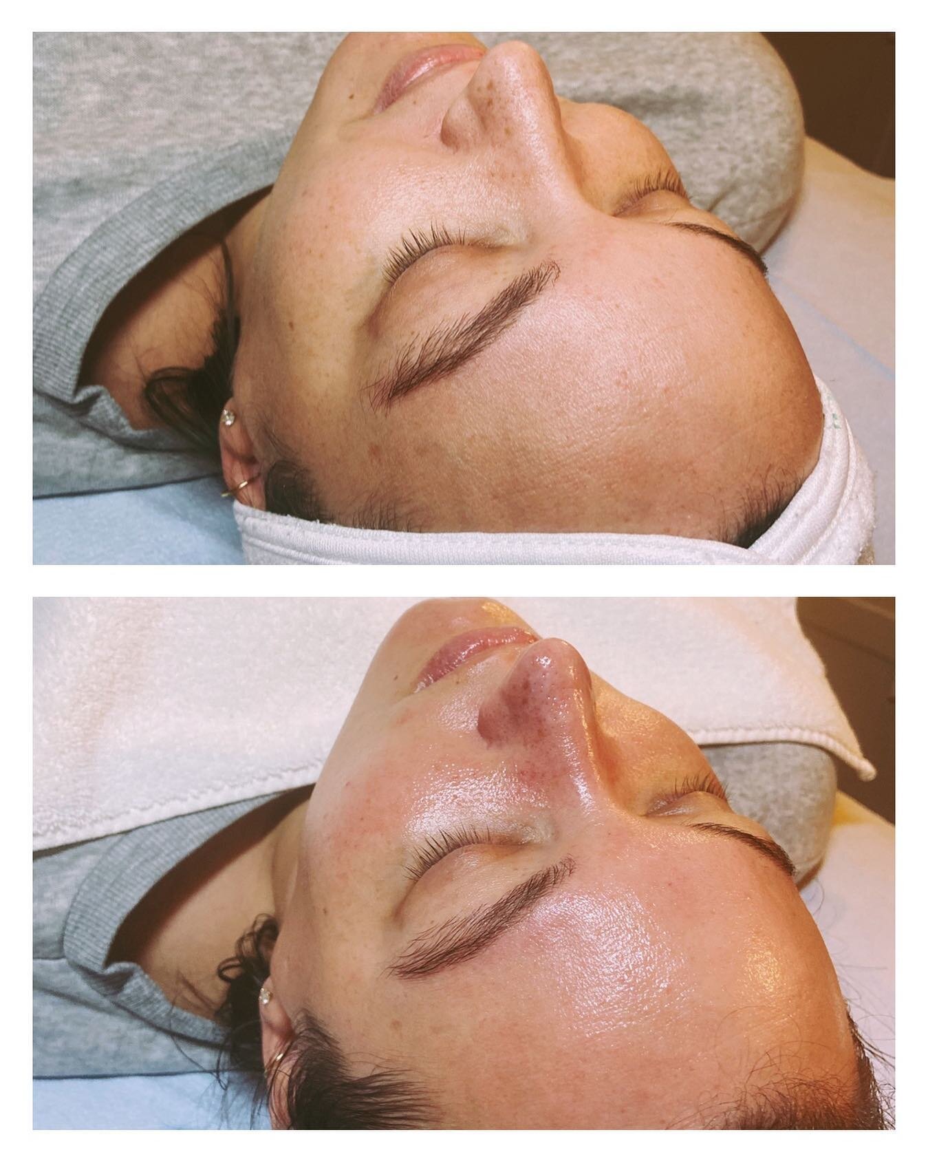 🌿 Still crushing on this before &amp; after of an HM Custom Facial. 

With the crazy temperatures, heaters and dry air she was in need of some good hydration!

#customfacial #customskincare #hmaesthicsllc #hydration #skintips #advancedesthetics #bos