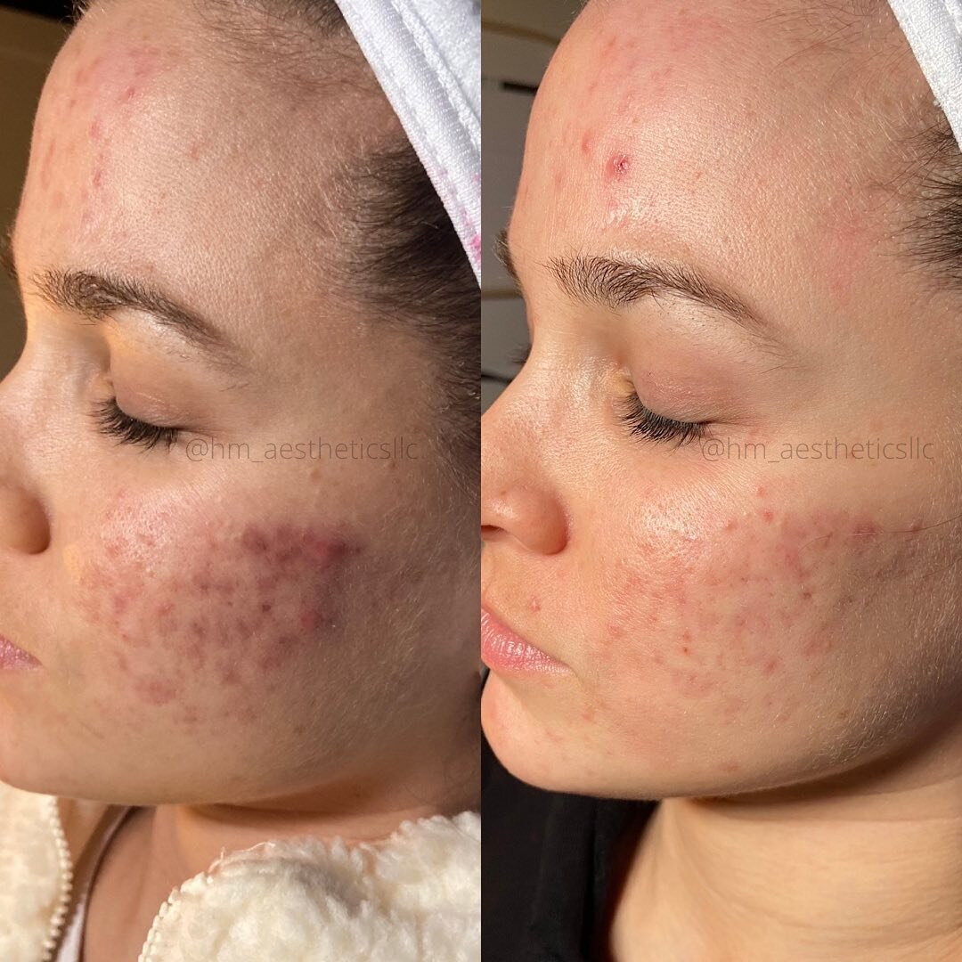 🌿 Acne Progress 

Getting her inflammation under control was key, look how much brighter her cheeks are!