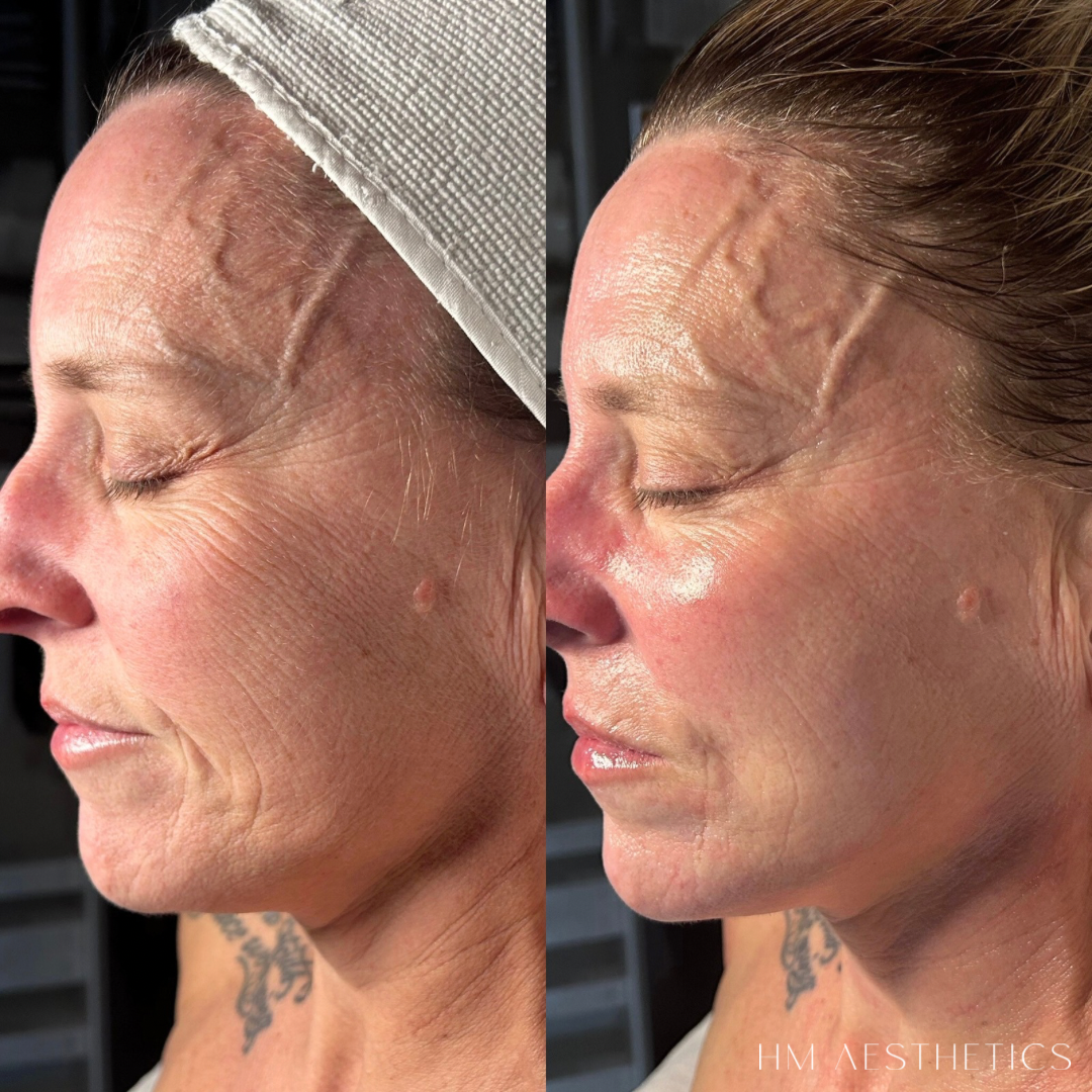 Side-by-side comparison of a woman's face before and after skincare treatment showing reduced wrinkles, improved skin texture, and a more radiant complexion.