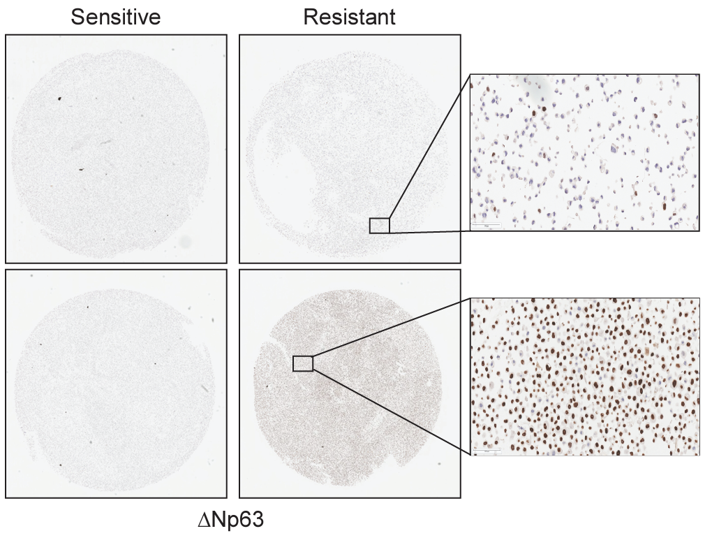 Garcia NMG, Becerra JN, McKinney BJ, DiMarco AV, Wu F, Fitzgibbon M, Alvarez JV. APOBEC3 activity promotes the survival and evolution of drug-tolerant persister cells during acquired resistance to EGFR inhibitors in lung cancer. bioRxiv (2023)