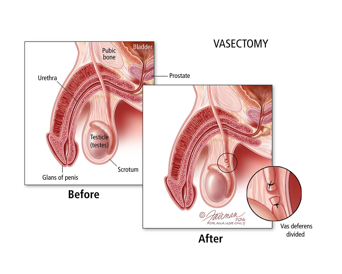 No Scalpel Vasectomy — Hari Sawkar MD