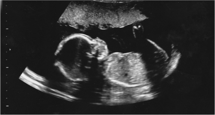 what about abortion