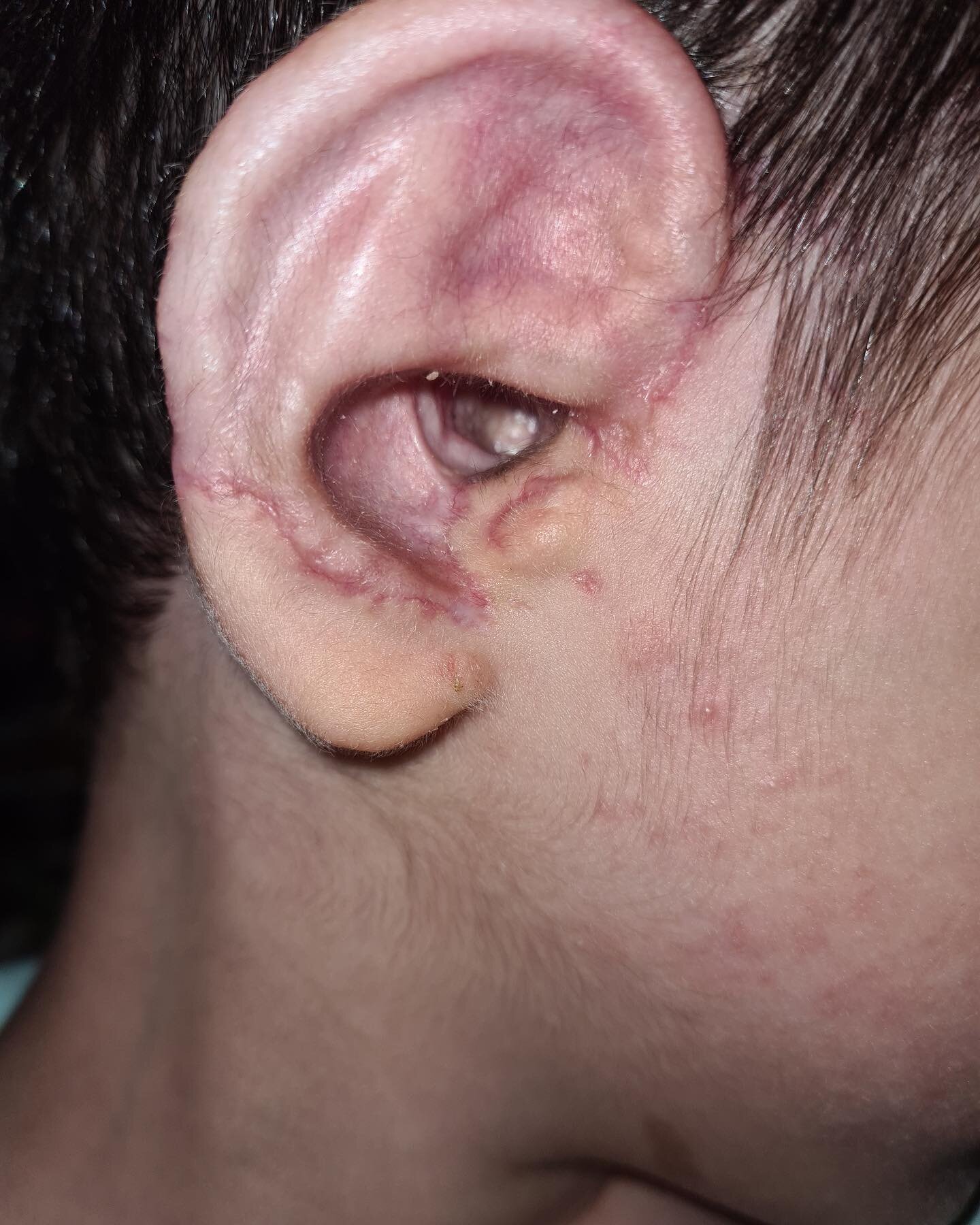 Here is a picture of a right ear reconstruction on a delightful 5-year-old patient from Israel! 🇮🇱👂🏻 This photo is of the ear 9 weeks after combined surgery on the right side, with the canalplasty by Dr. Roberson and the outer ear Medpor reconstr