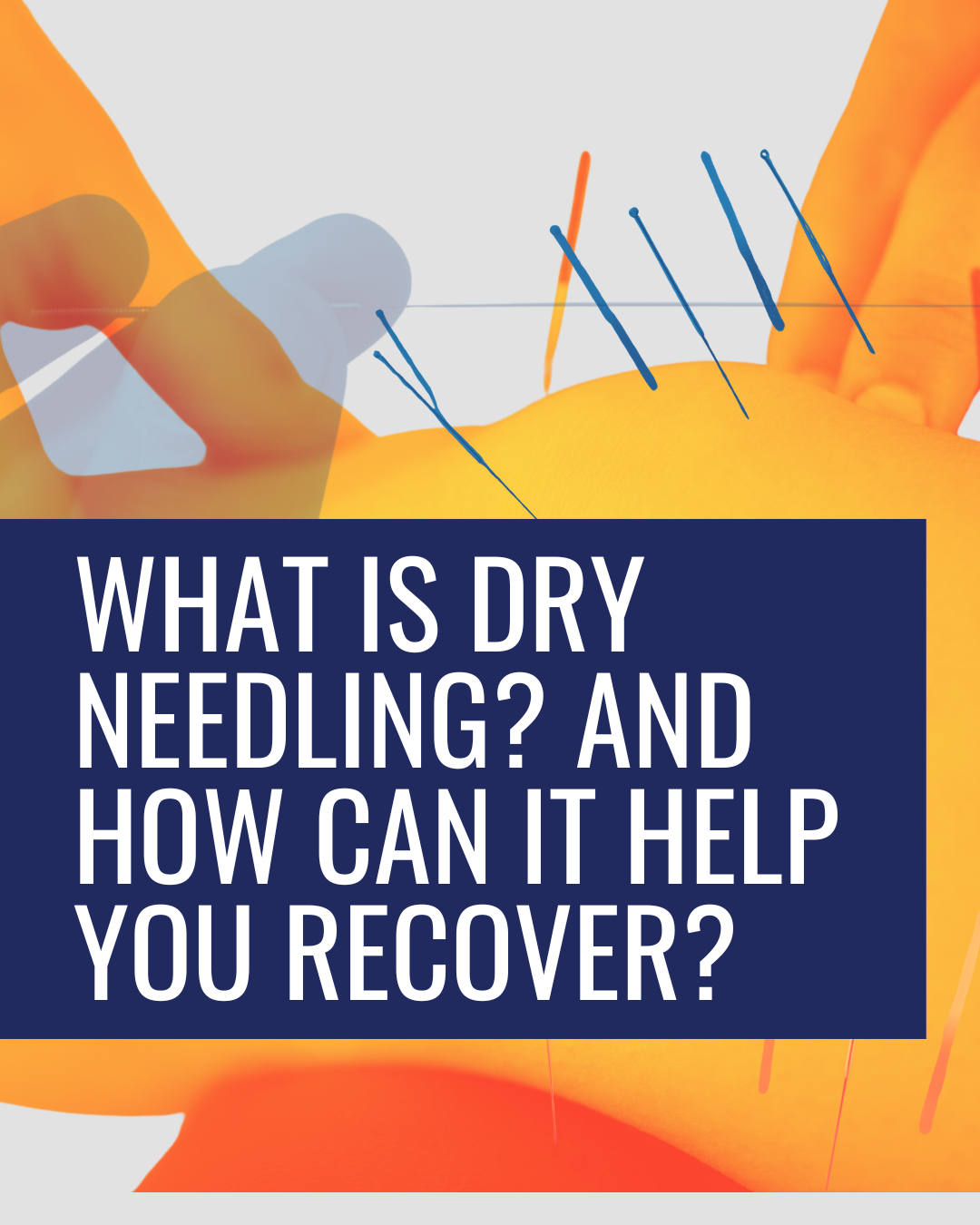 What is Dry Needling and How Can It Help You?