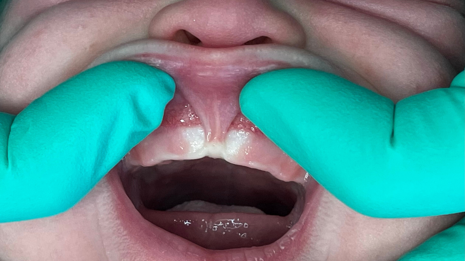 Lip Tie shown by Dr. Samira Jafari - Atlanta Airway Dentist