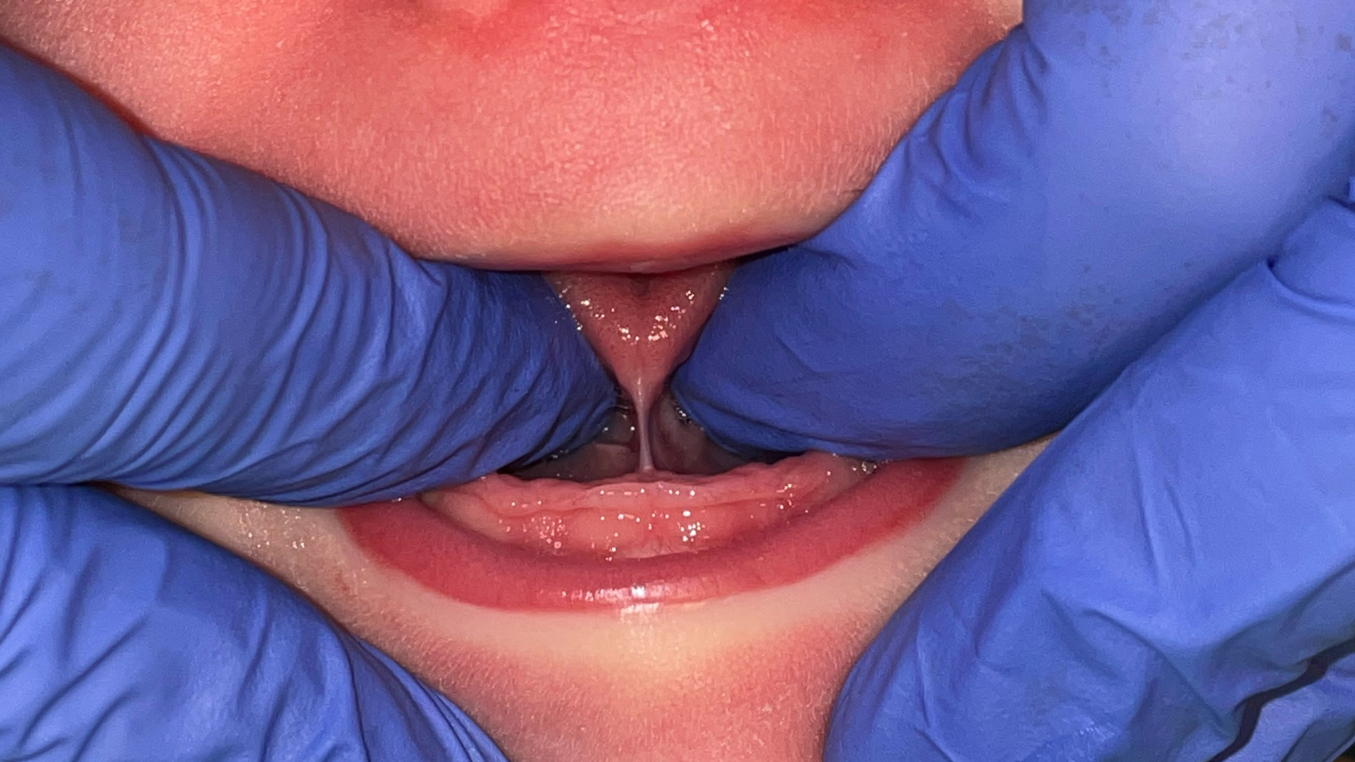 Tongue Tie shown by Dr. Samira Jafari - Atlanta Airway Dentist