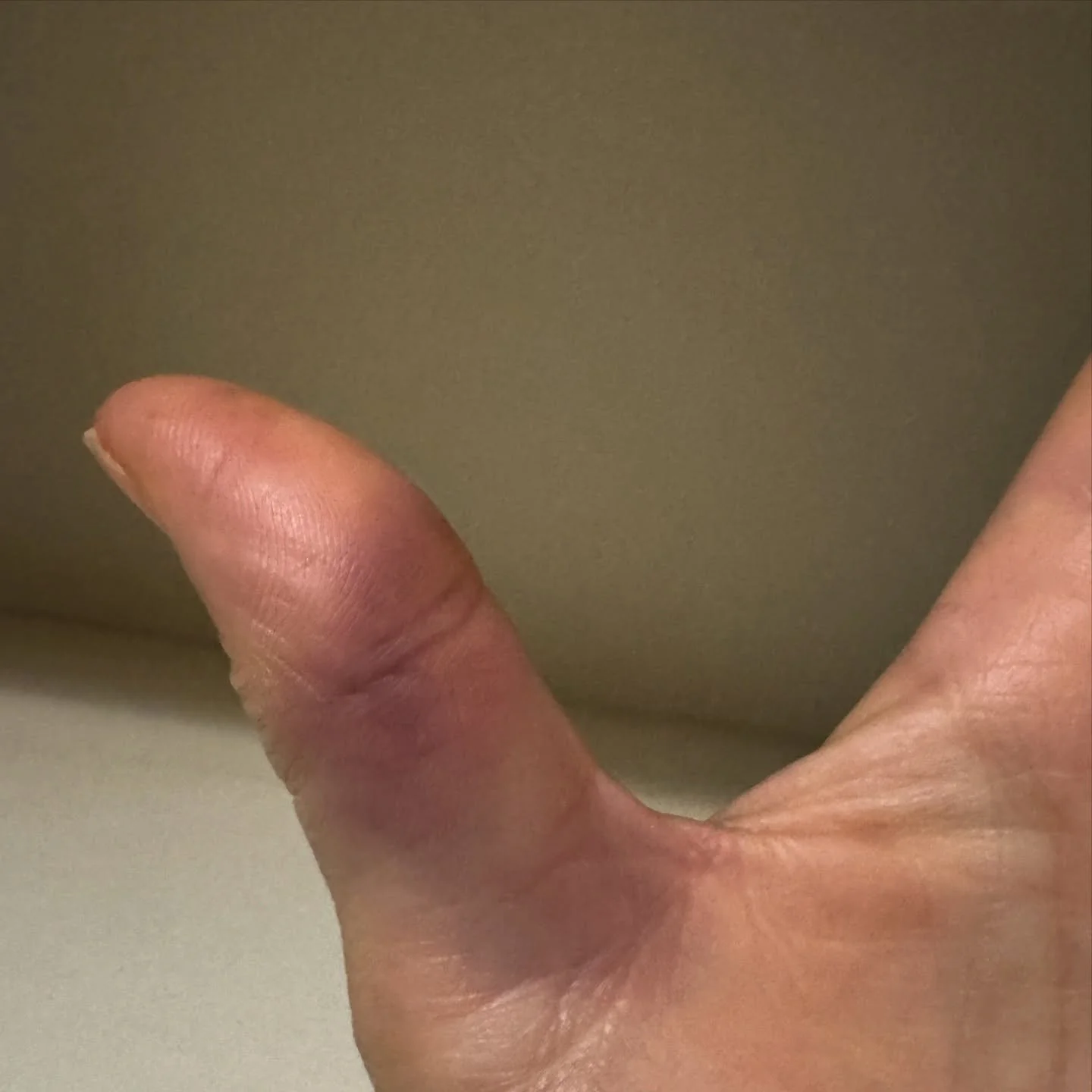Any ideas? 

This is the second time I have experienced this on my left thumb. It comes up suddenly and looks a bit like a bruise. It feels tender as if I have knocked it but I haven&rsquo;t knocked it. 

I think it might be something to do with harv