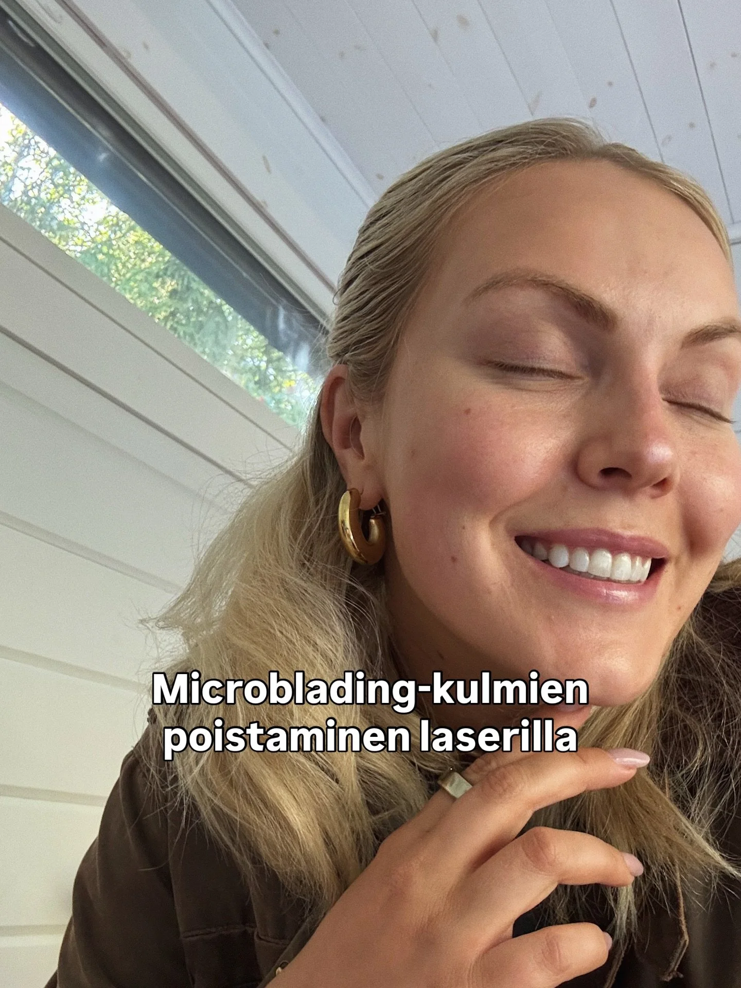Mainos: @bnsclinic / Mun viime vuoden paras p&auml;&auml;t&ouml;s oli laseroida microbladingit mun kulmista, mit&auml; olin miettinyt jo pidemp&auml;&auml;n. 😮&zwj;💨 

Vuosien saatossa microbladingin v&auml;ri oli tummunut, muuttunut siniharmaaksi 