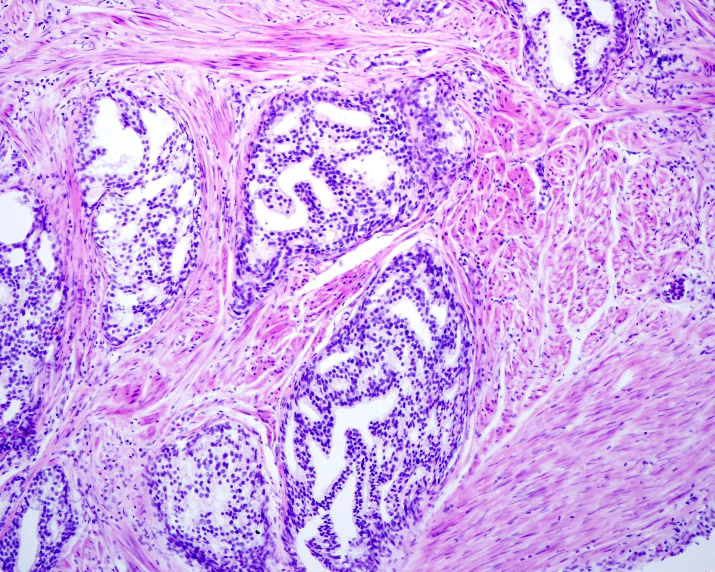 Large Cribriform Pattern 4 Cribriform — OncoAssure - Precision Tests for Oncology