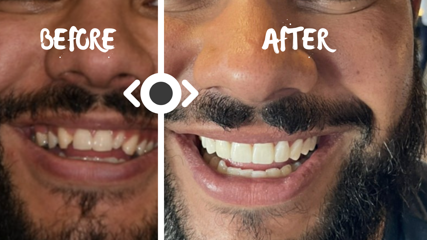 Cosmetic Veneers