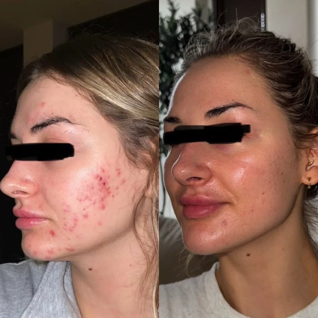 Microneedling before and after for enlarged pores